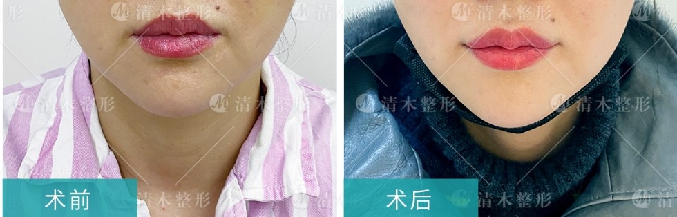 1,天生走势向下, 2,因衰老皮肤松弛造成的嘴角下垂, 3,降口角肌发达