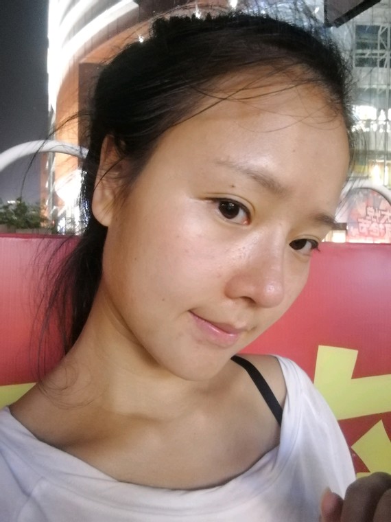 鼻修复三次,半肋膨体鼻综合笑起来僵硬,怎么回