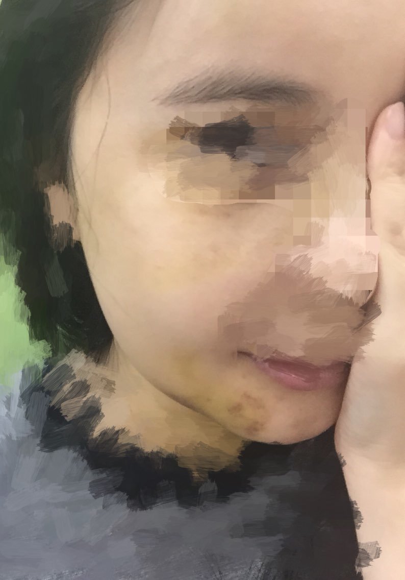 今天第十天,嘴巴的线都拆了,除了左边淤青比较多