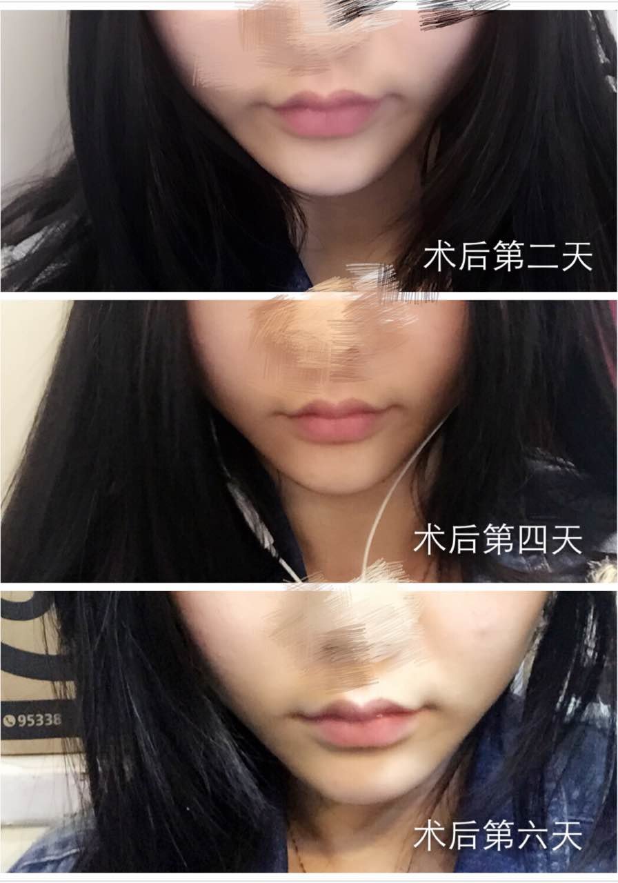 话说以前我都不觉得垫下巴重要,现在对比好明显有没有!超自然!