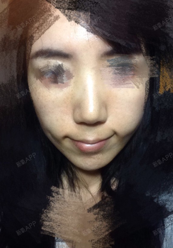 右脸不仅颧鼓得更高,下面还有一个脂肪包,蚊子包那么大,求消退