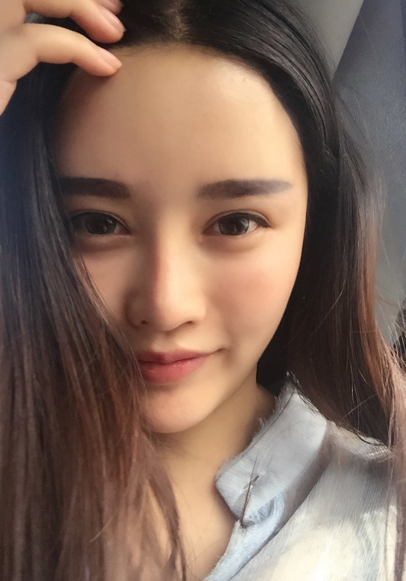 头三天因为包扎起来了,我自己看不到,最后换药的时候照了镜子看到额头