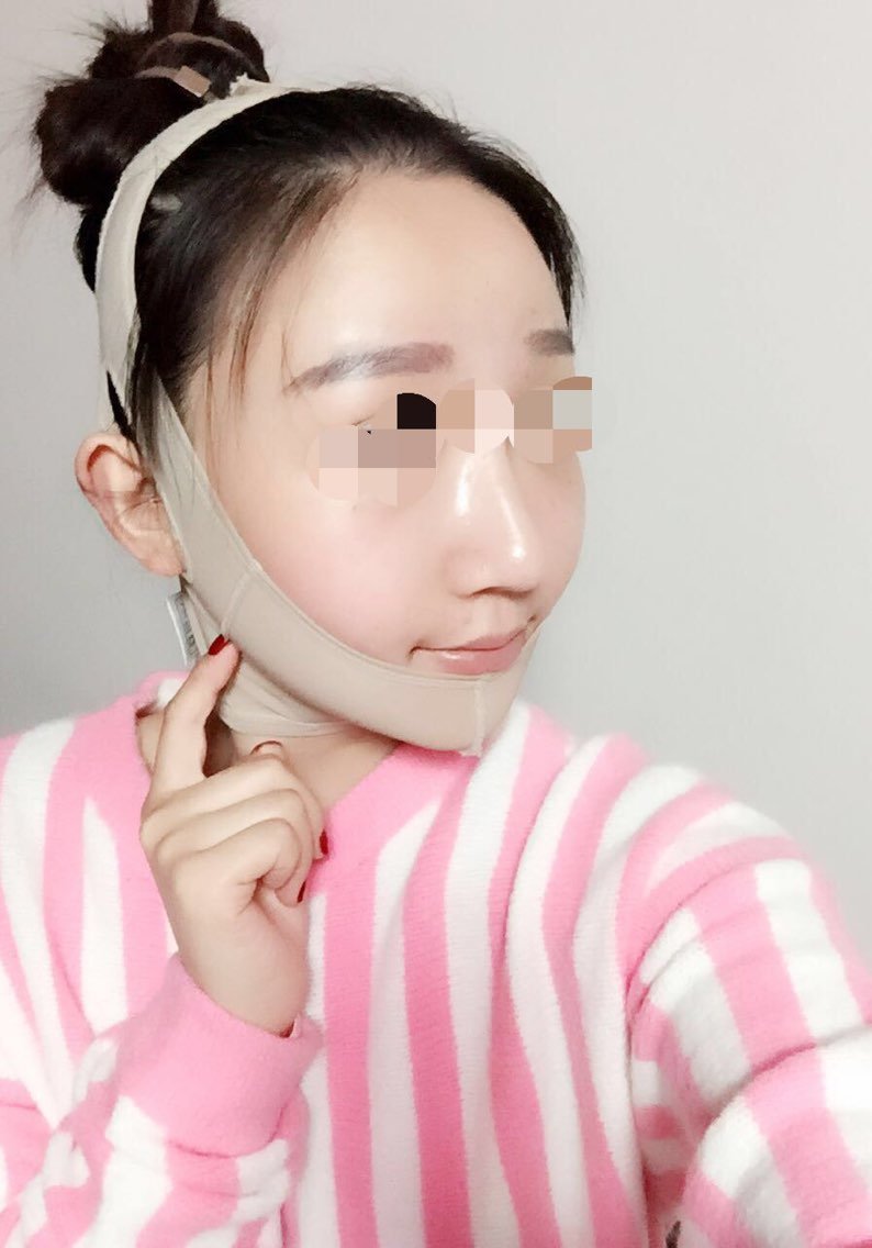 半折断不固定颧骨颧弓内推手术同步下颌骨点状定位长曲线全层截骨手术