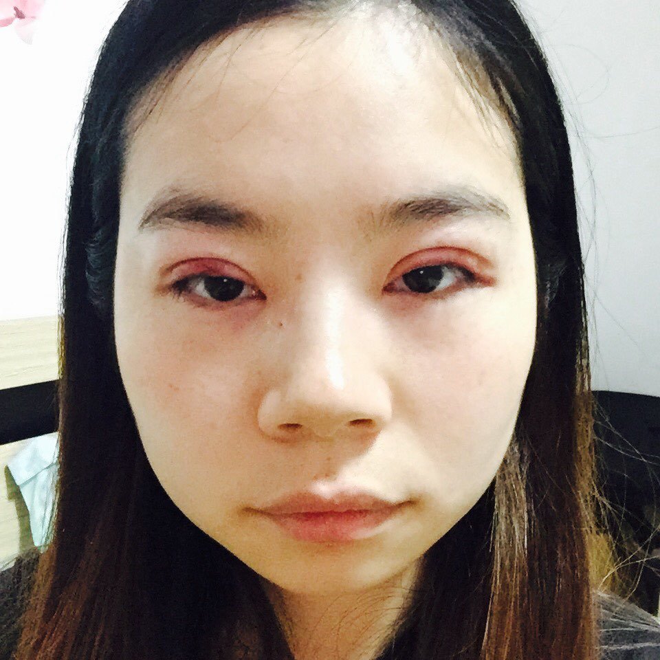 开内眼角第1天