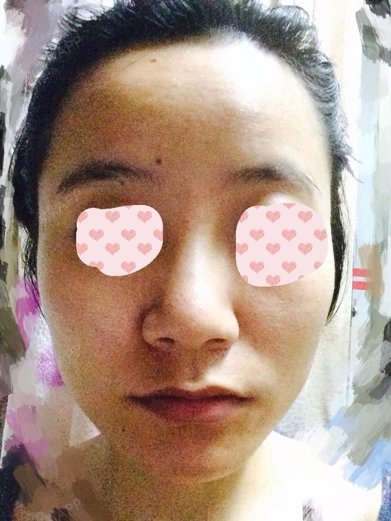 为什么我的鼻子,嘴巴,下巴,都是红红的?
