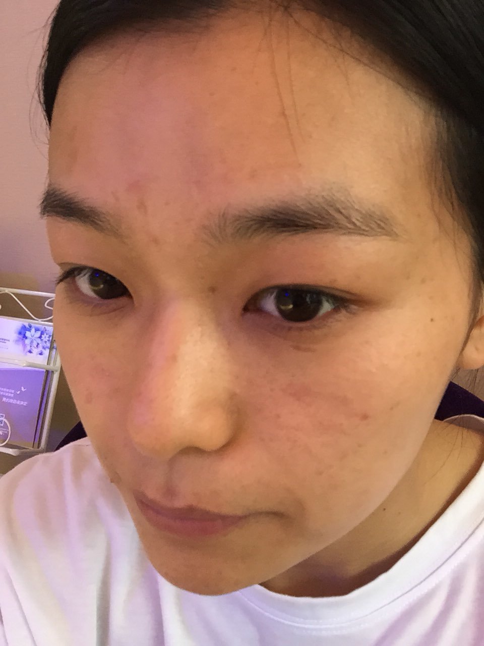 今天来做黑脸娃娃,前两张是做之前照的,粉刺明显比之前小了许多,后面