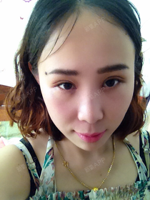 :-*luse冰冰全切开双眼皮第25天美丽日记-新氧