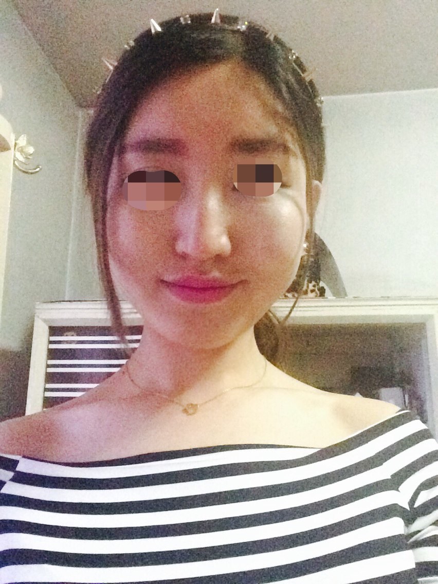 新氧 为什么我是脸大2 术后当自强 注射肉毒素痩脸(瘦脸针)