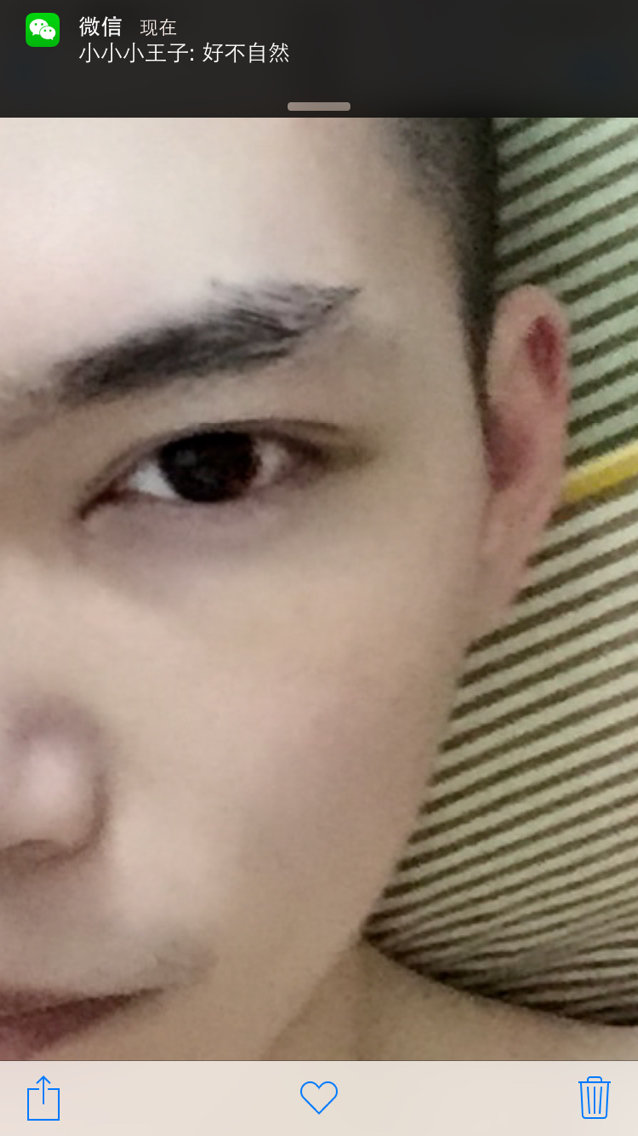 白鹤大人 | 术后当自强 | 开内眼角 | 开眼角 | 眼部整形 | 男生整形