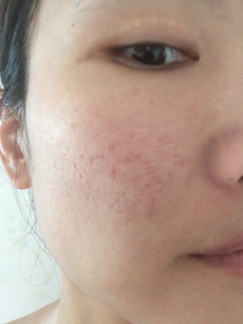 已经两周了,印子比较淡了,疤痕处还是有些色素沉着,慢慢等恢复.