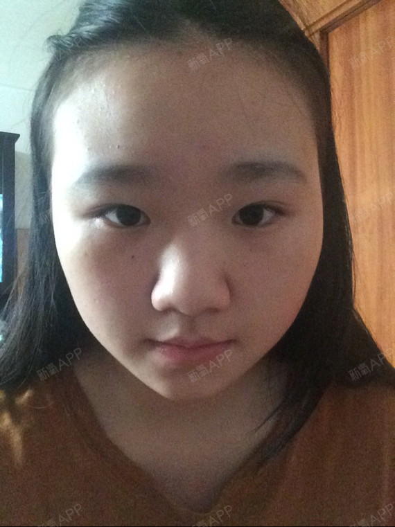 我真的很想改变自己的五官,特别没自信。鼻子