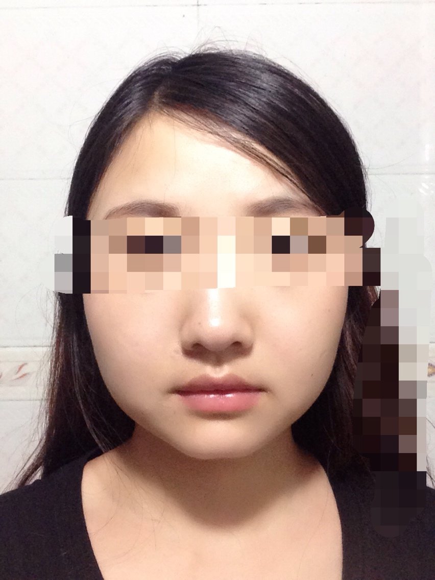 今天终于鼓起勇气打了瘦脸针啦.婴儿肥的脸啊我苦恼死了.