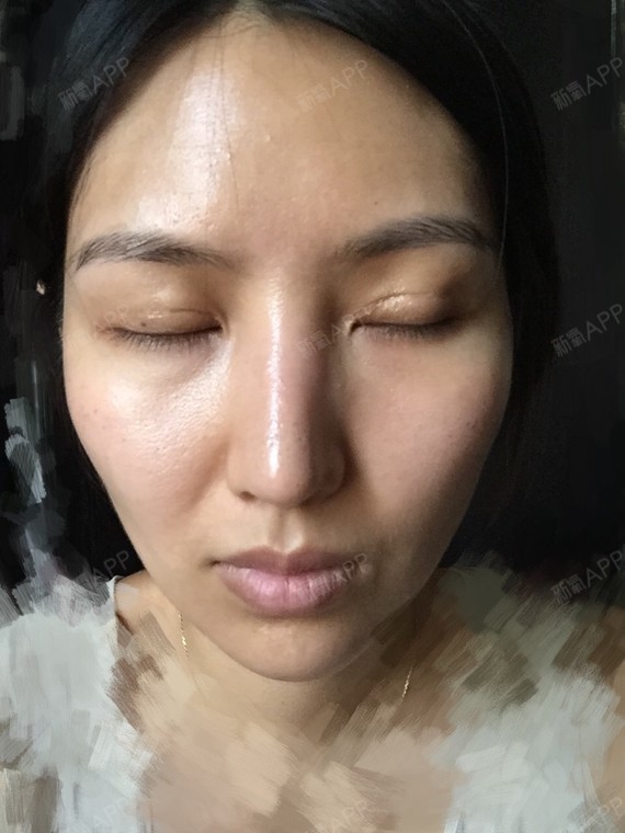 乔巴的公主宽鼻矫正第79天美丽日记-新氧美容