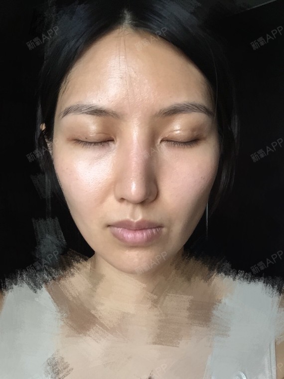 乔巴的公主宽鼻矫正第79天美丽日记-新氧美容