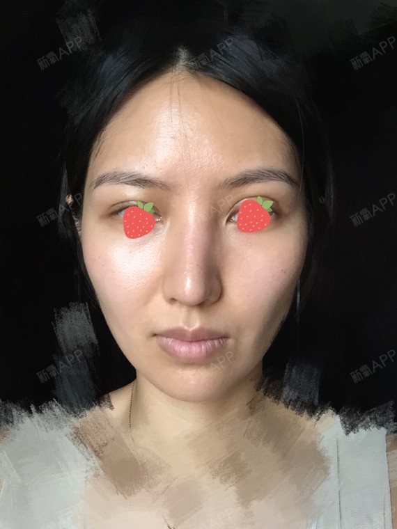 乔巴的公主宽鼻矫正第79天美丽日记-新氧美容