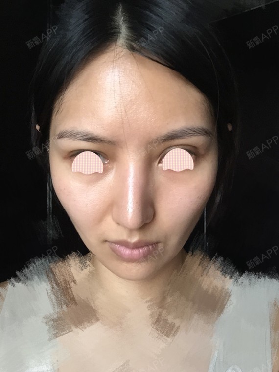 乔巴的公主宽鼻矫正第79天美丽日记-新氧美容