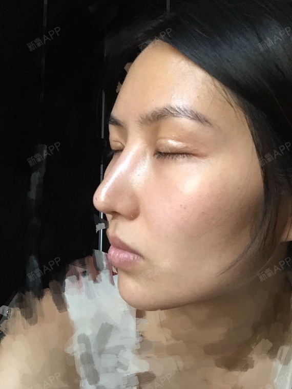 乔巴的公主宽鼻矫正第79天美丽日记-新氧美容