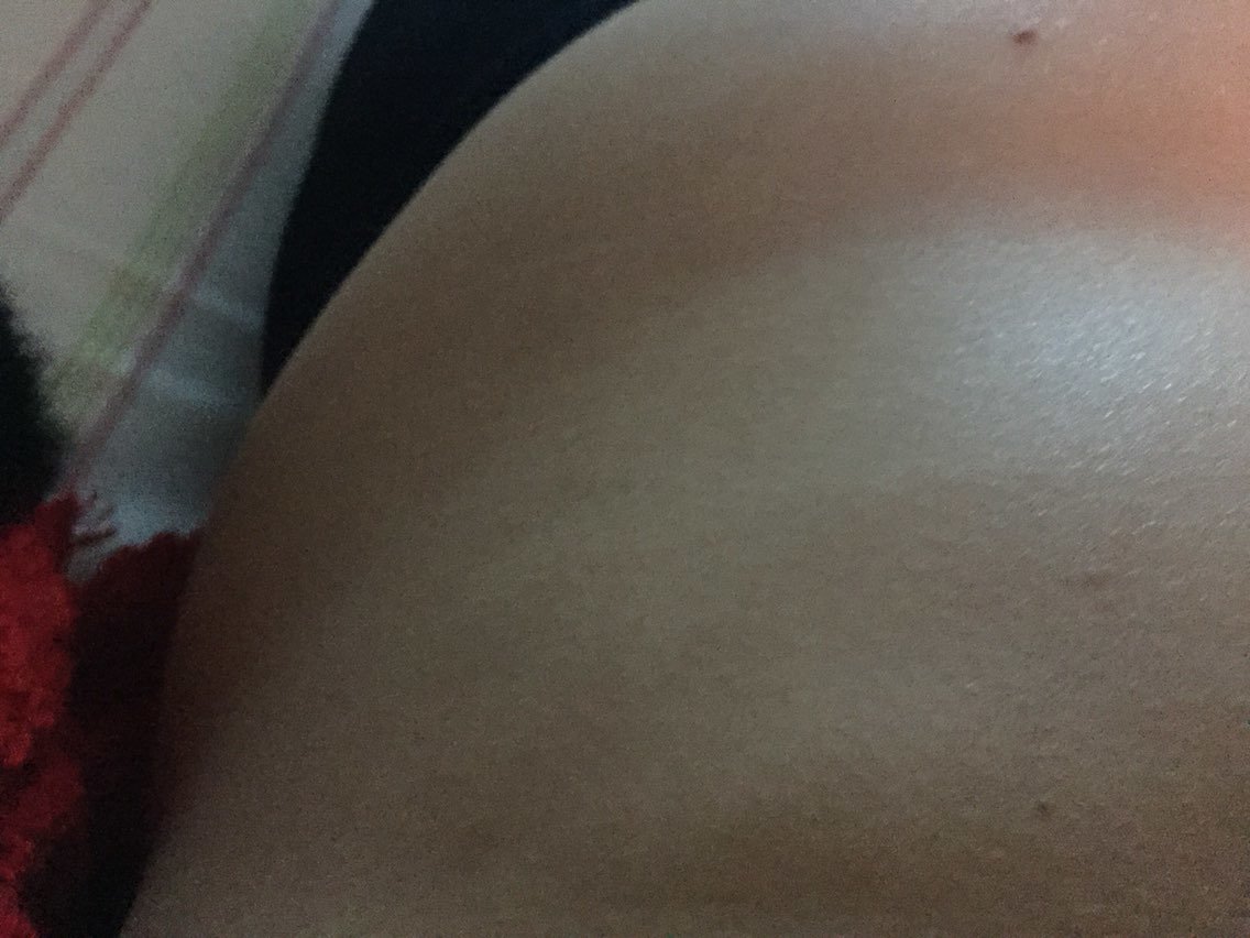 之前肚子非常大!后来打了溶脂针!前后对比还是瘦了很多!