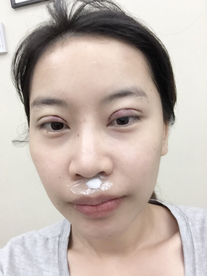 全切双眼皮第一天哦
