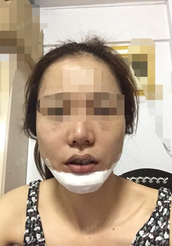 刚做完假体下巴,下巴真的很紧.做的过程心都要跳出来了.