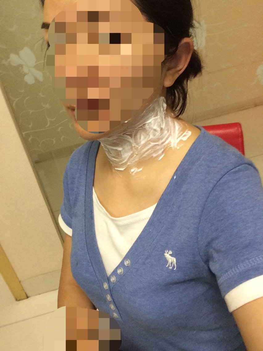 打溶脂针,溶了脖子上的肉肉,一点也不疼,第三天也没肿,期待效果啦～丰