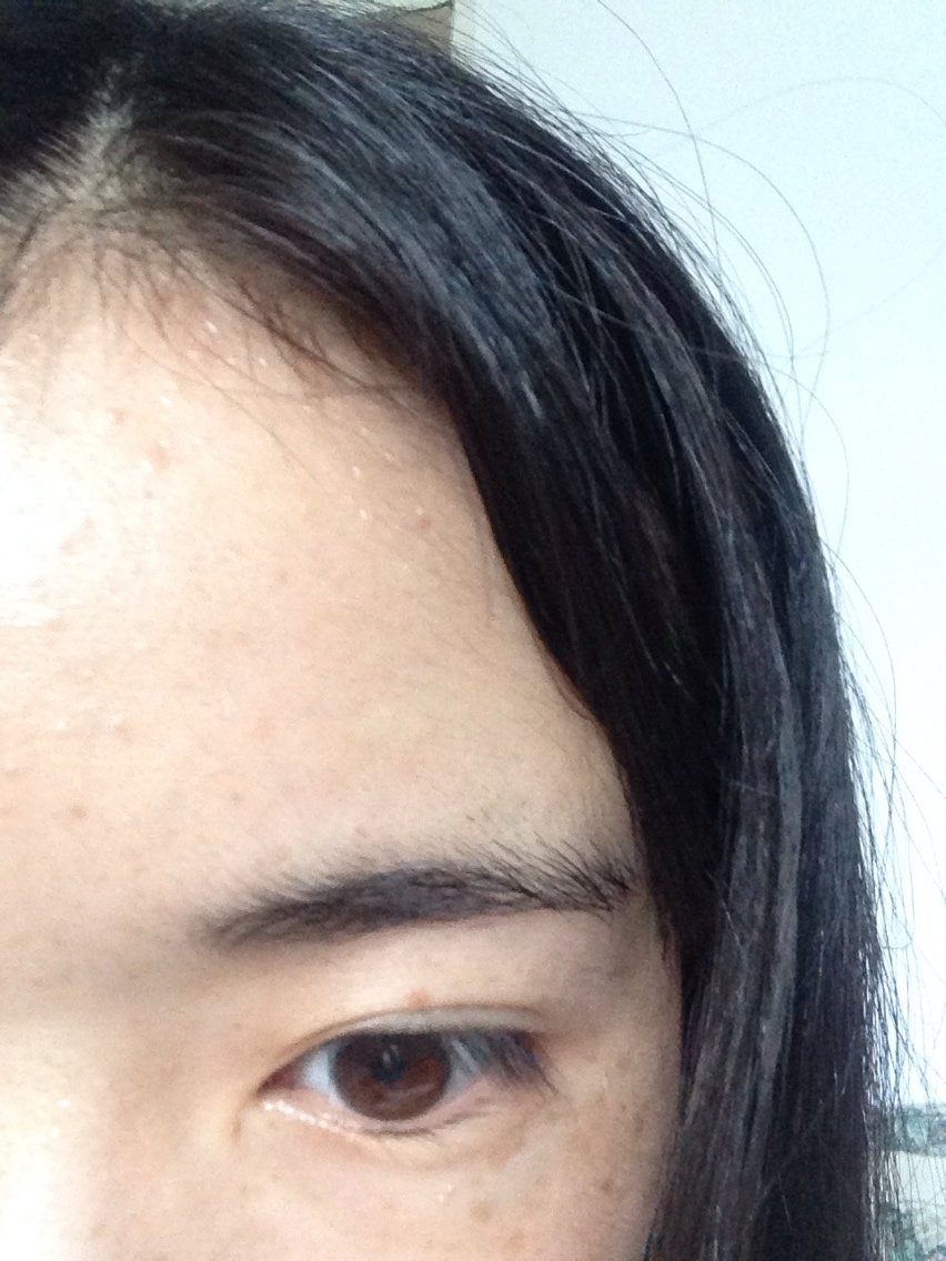 眼睛肉肉的,很肿.能打溶脂针吗?还是开刀切除多余脂肪