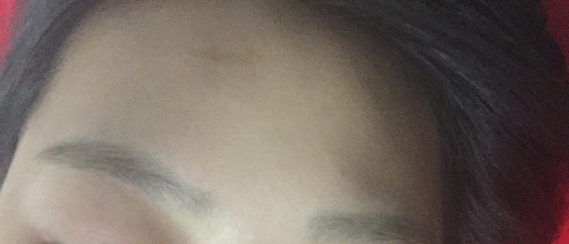 额头上有一个小时侯缝针的疤,有的时候一抬头疤痕看着特别不舒服,想把