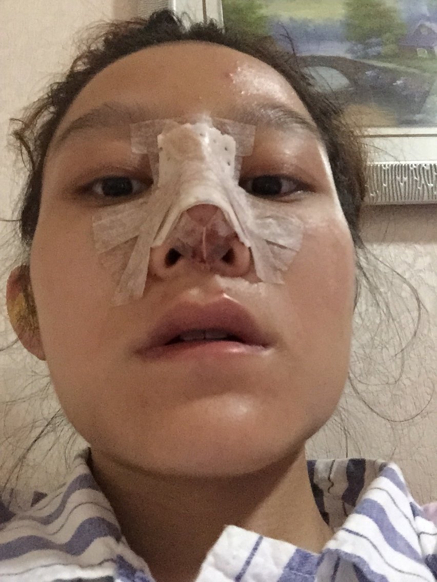 今天术后第一天,鼻子以下肿得来透亮了.大家帮忙看看