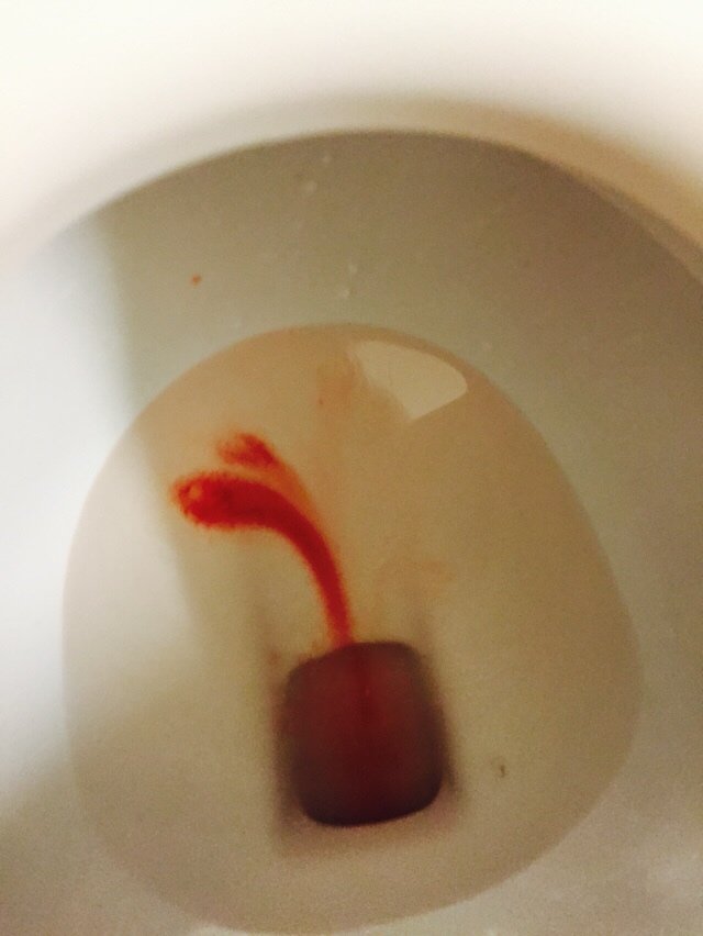 我本来明天手术的今天突然得了急性膀胱炎尿血昨天体检到今天去医院被