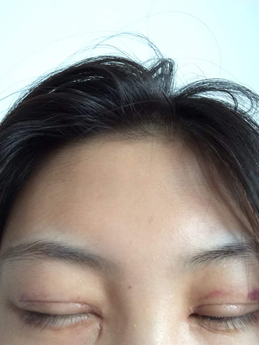 眼睛刚做完20天 提肌 开眼角 是增生了吗 有没有知道的亲爱的