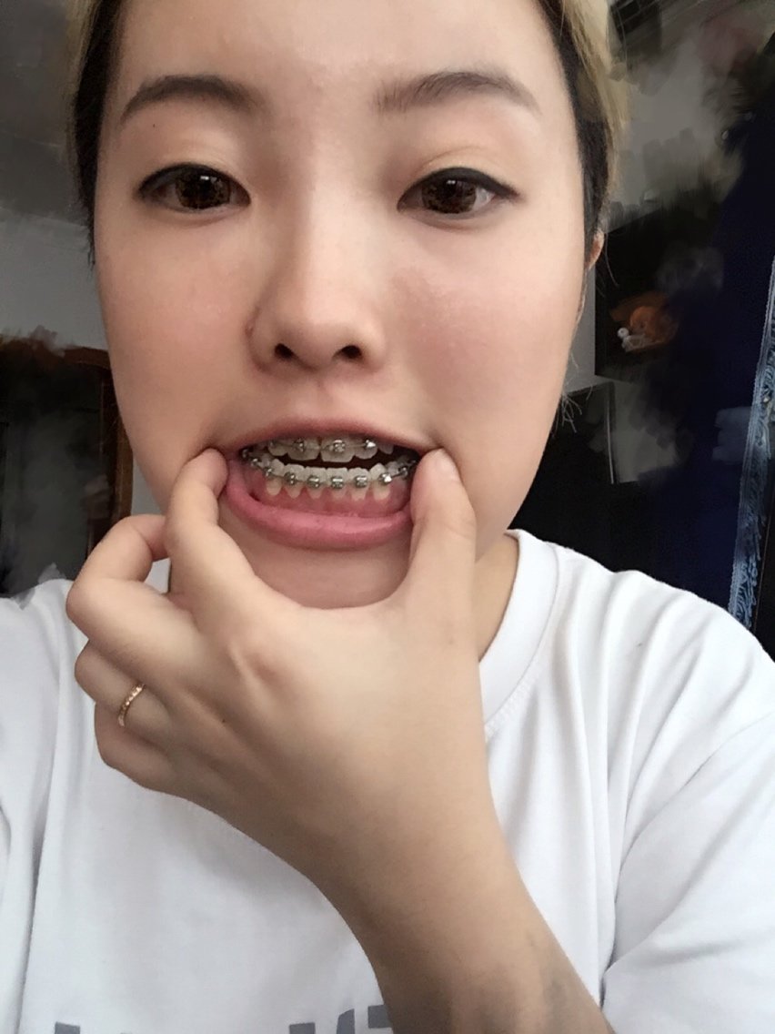我可爱的老虎牙没啦
