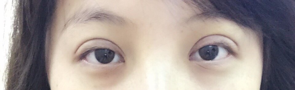 今天做了埋线双眼皮,我本身是内双,而且大小眼比较明显,做完的图片是