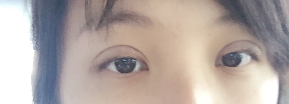今天做了埋线双眼皮,我本身是内双,而且大小眼比较明显,做完的图片是