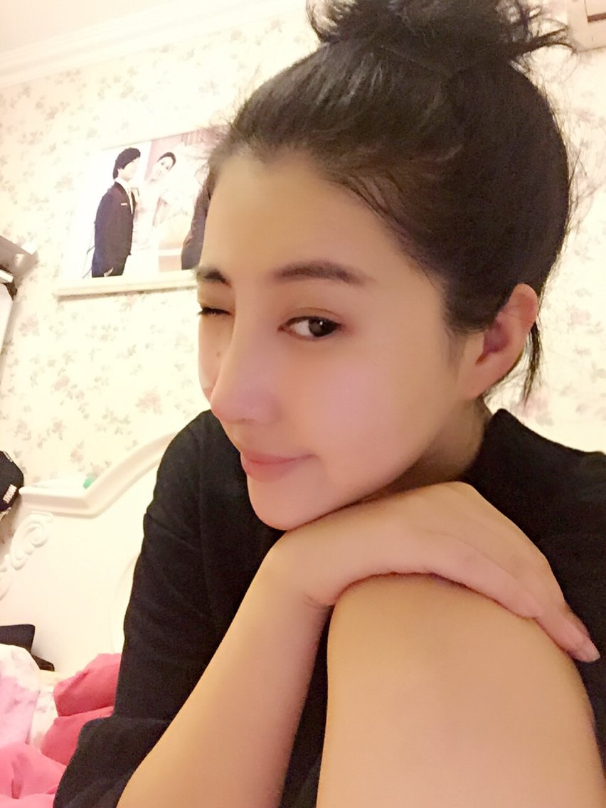 手术已经过来12天了,正面有点肿肿的,我做的是自体肋软骨隆鼻,除了