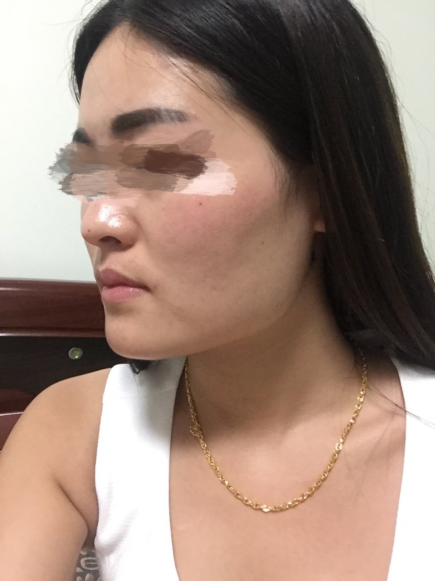 第一次尝试打瘦脸针,这次是选在上海浦东华美医院.之前去了解过一次.
