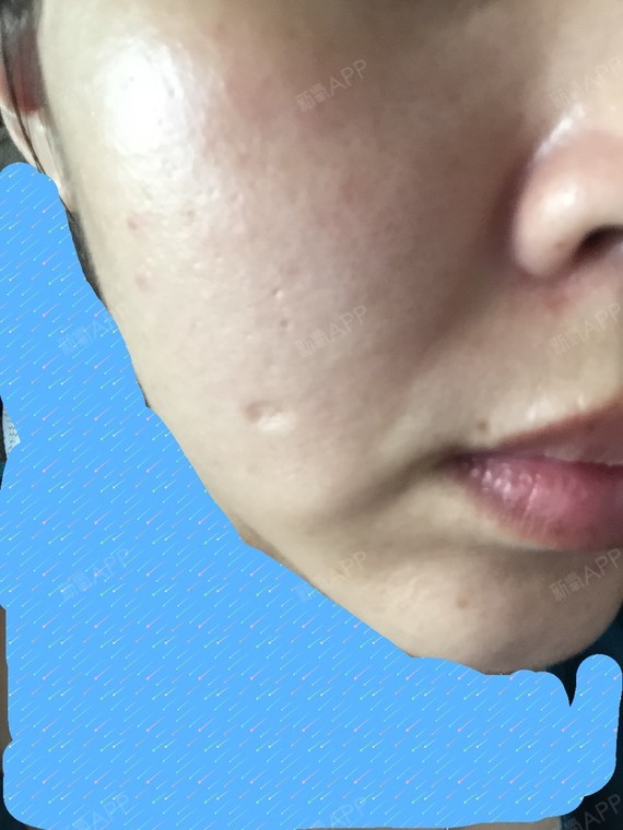 嘴角有木偶纹要怎么处理呀…求解…困扰我很久了～555