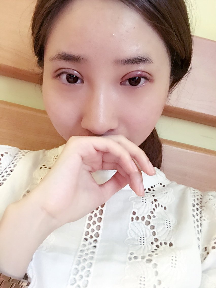 新氧- 阿yu儿 | 术后当自强 | 韩式三点双眼皮 | 眼部整形 | 双眼皮