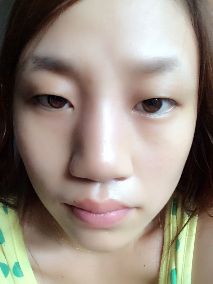 昨天下午打的玻尿酸隆鼻!今天还是肿,看着变化也不大