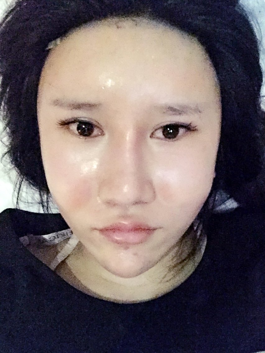 于小洋越变越美自体脂肪丰额头第8天美丽日记-新氧