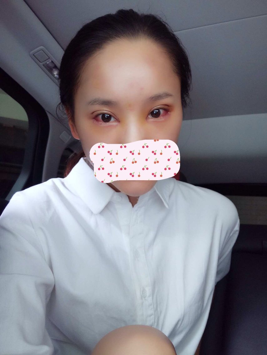 新氧- 小思思 | 术后当自强 | 外眼角下拉 | 埋线法双眼皮 | 眼部整形