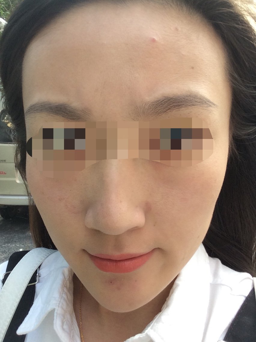 第一次做黑脸娃娃,没有明显的改善,毛孔没有变化,黑头也还是很多,做了