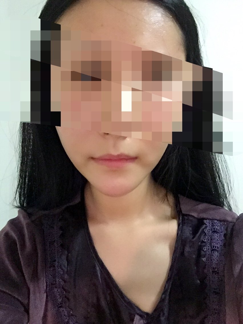 对比 之前打玻尿酸的下巴 和 现在垫了假体的下巴 现在的下巴又圆又大