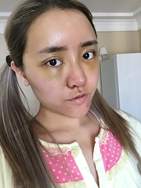鼻子上的胶带痒痒的,撕下去啦,脸还是好肿~~大家平