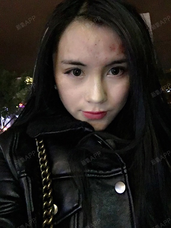 玻尿酸丰额头后有好多淤血和淤青还有好多针眼…这是正_圈子-新氧美容