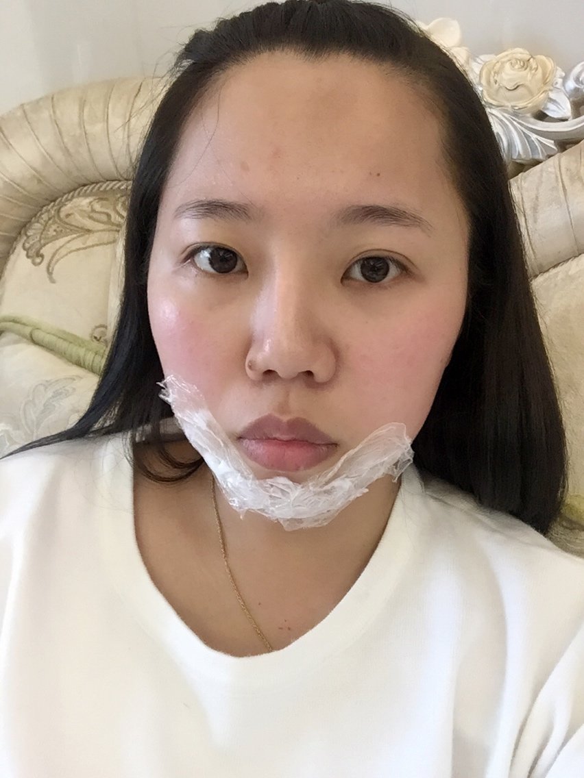 新氧 ail 术后当自强 玻尿酸垫下巴 注射丰下巴 面部轮廓