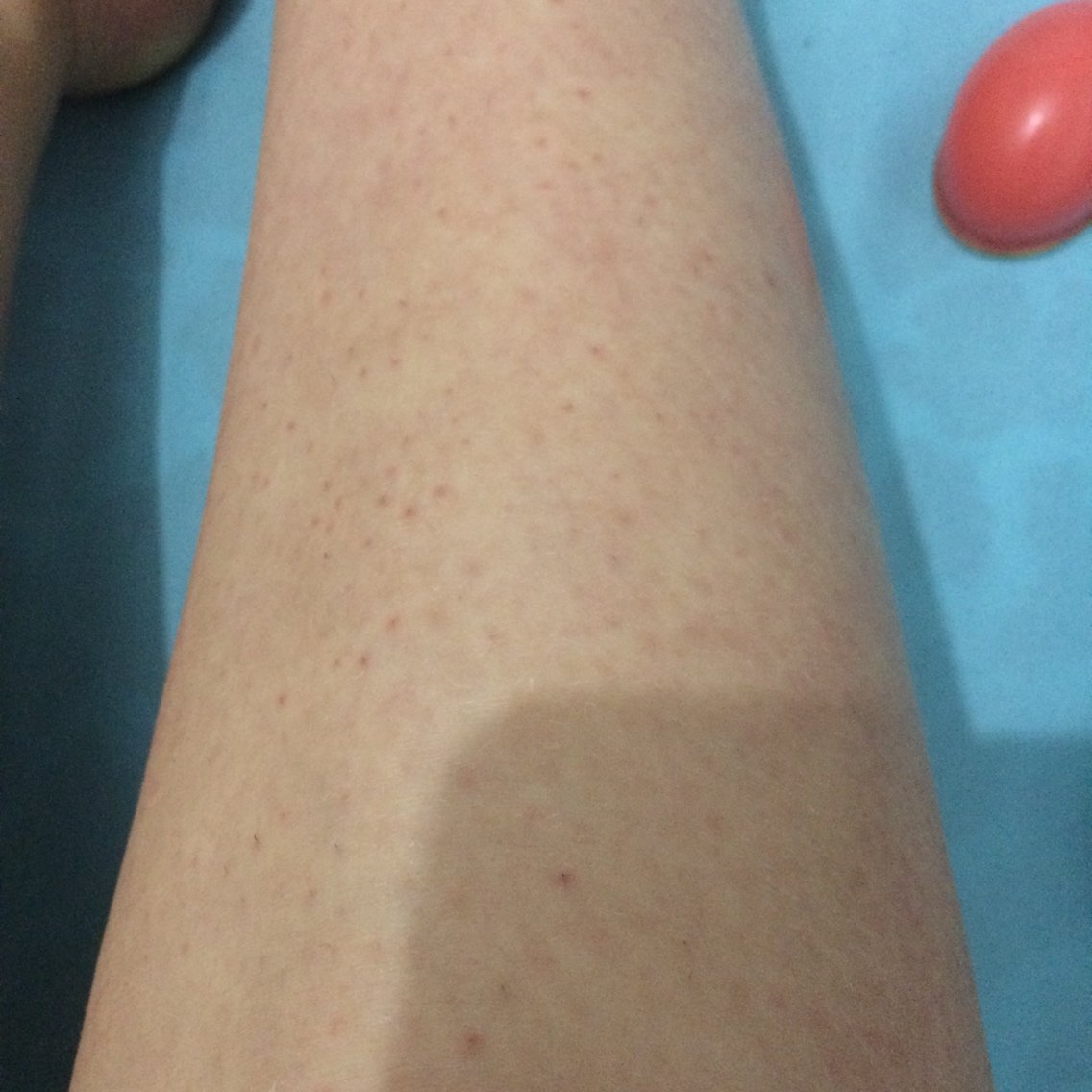 新氧- i_not_ok | 术后当自强 | 冰点脱毛 | 毛发 | 脱毛