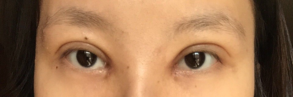 开内眼角第20天