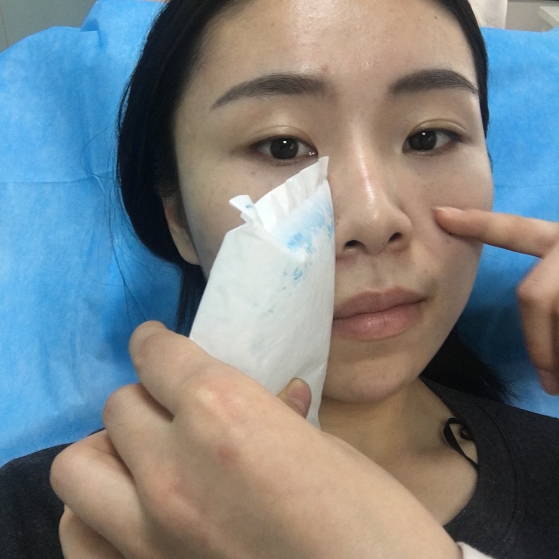 刚刚注射完法令纹人生第一次注射法令纹第一张是没注射之前第二张是