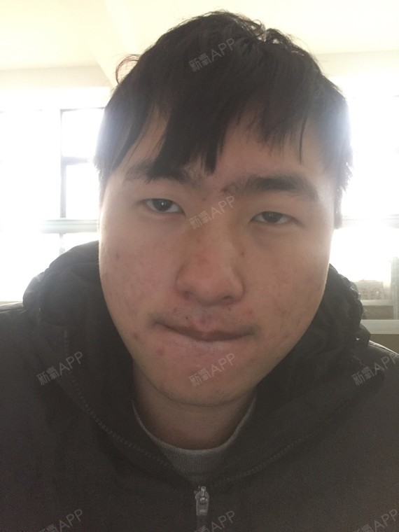 我的脸打瘦脸针有用吗?还有哪里需要整啊。_