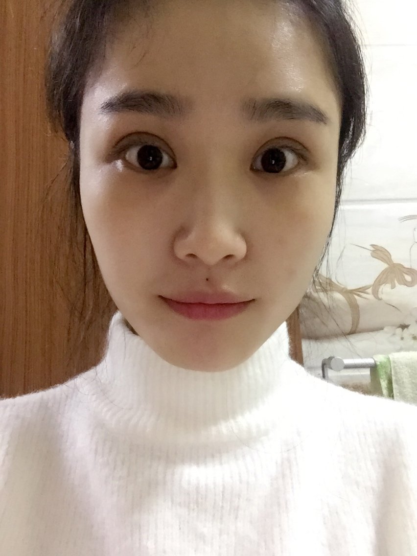至少不那么像金鱼眼了,我怎_圈子-新氧美容整形